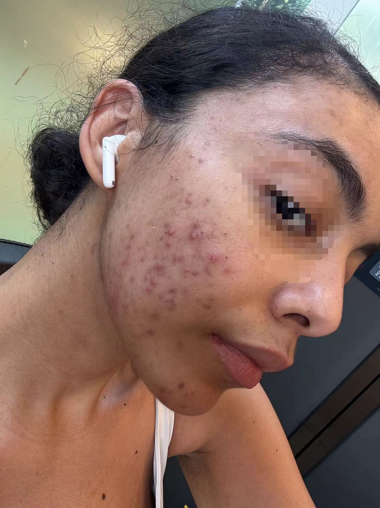 Customer skin progress photo, second angle