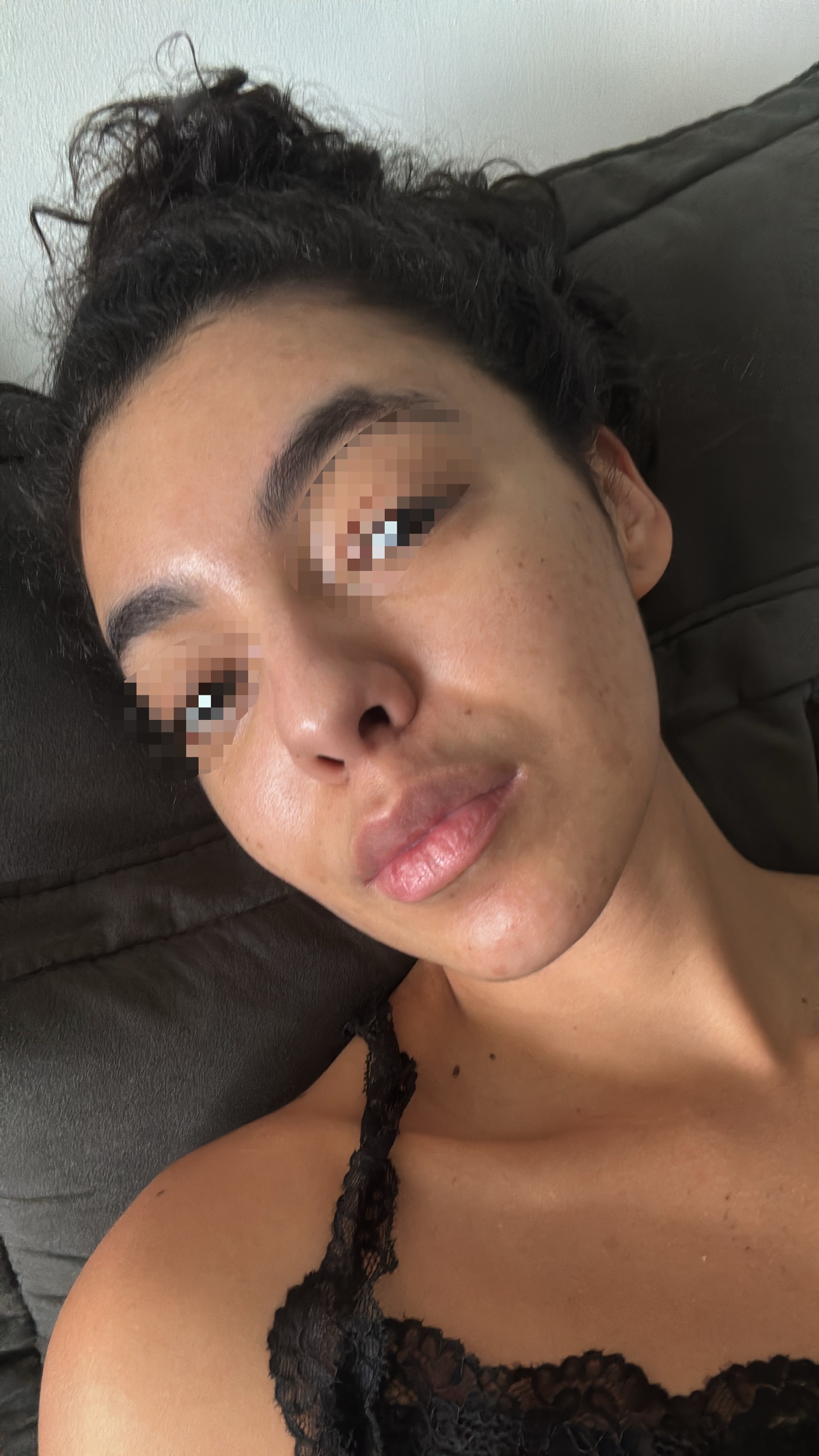 Customer selfie showing clearer skin, eyes blurred