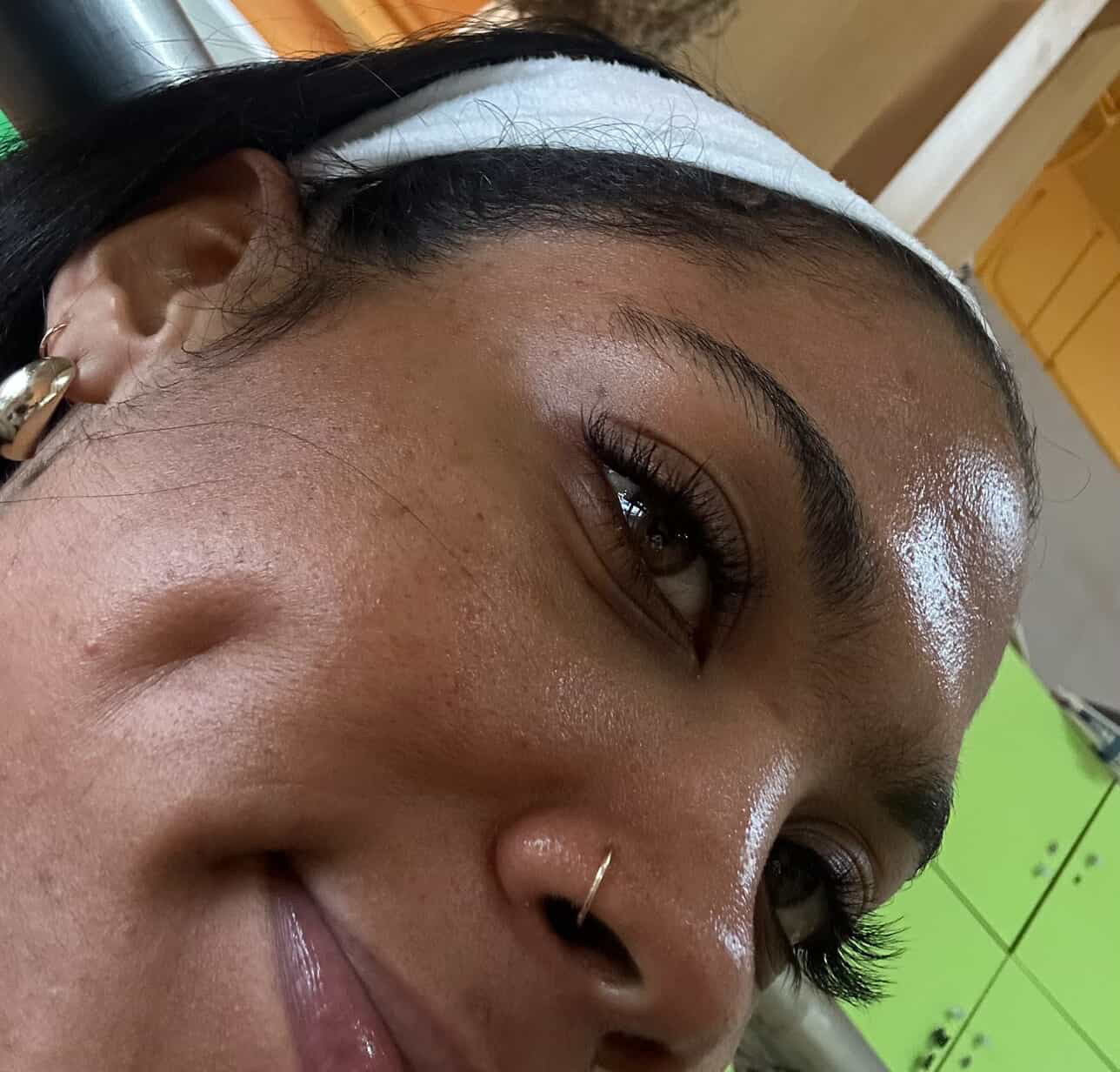 Customer skin progress photo, close-up